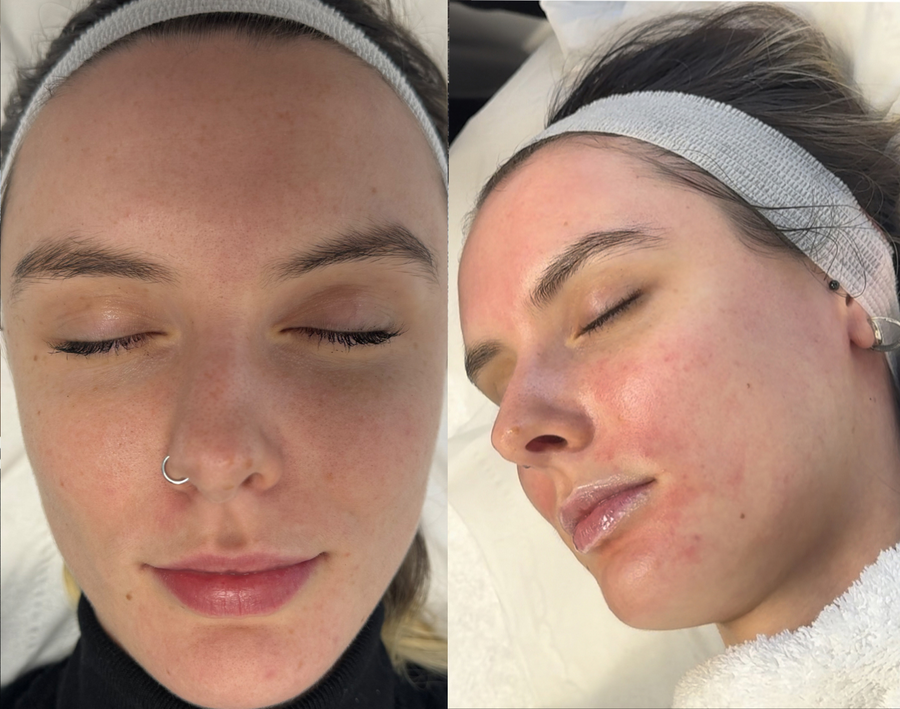 MelaQuest Mango Resurfacer